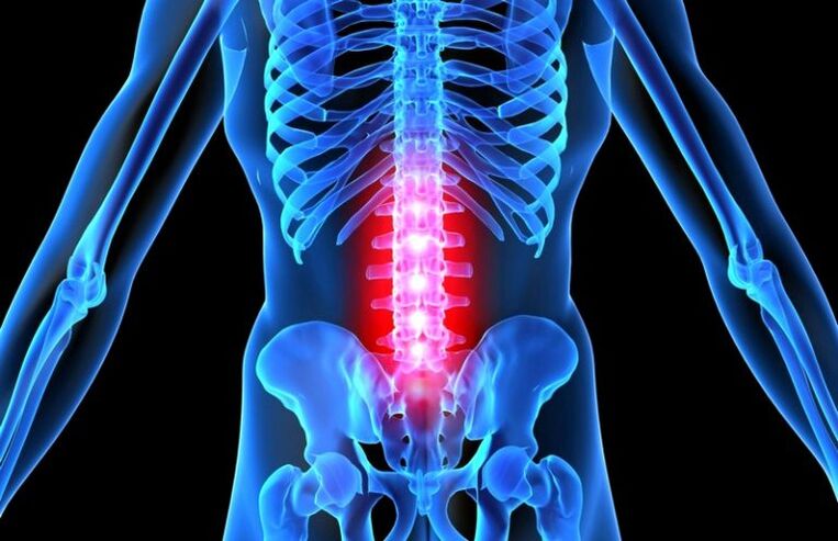 lézia chrbtice s bedrovou osteochondrózou