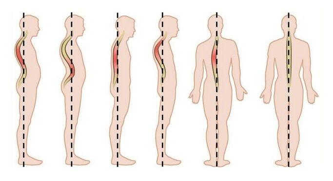 poruchy držania tela ako príčina hrudnej osteochondrózy