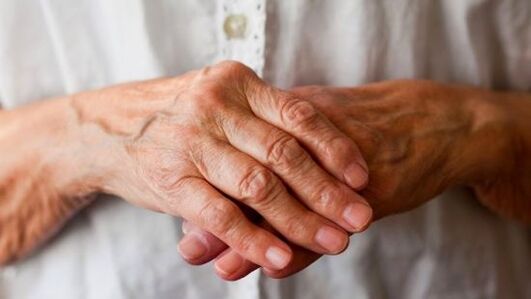 Reumatoidná artritída spôsobuje bolesť a opuch v kĺboch ​​prstov. 
