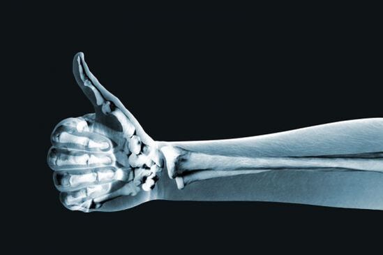 Röntgenové vyšetrenie môže pomôcť diagnostikovať bolesť v kĺboch ​​prstov