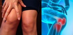 Nepohodlie a opuch v oblasti kolena sú prvými príznakmi artrózy