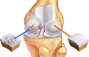príčiny artrózy kolenného kĺbu